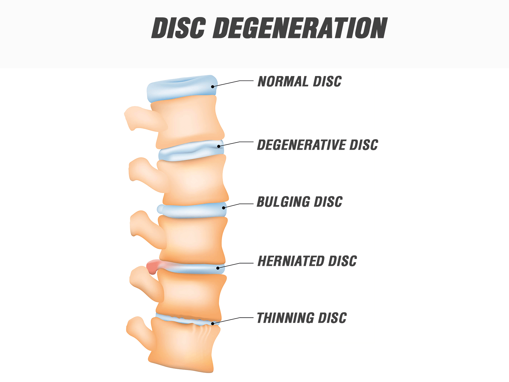 Degenerative Bandscheibenerkrankung