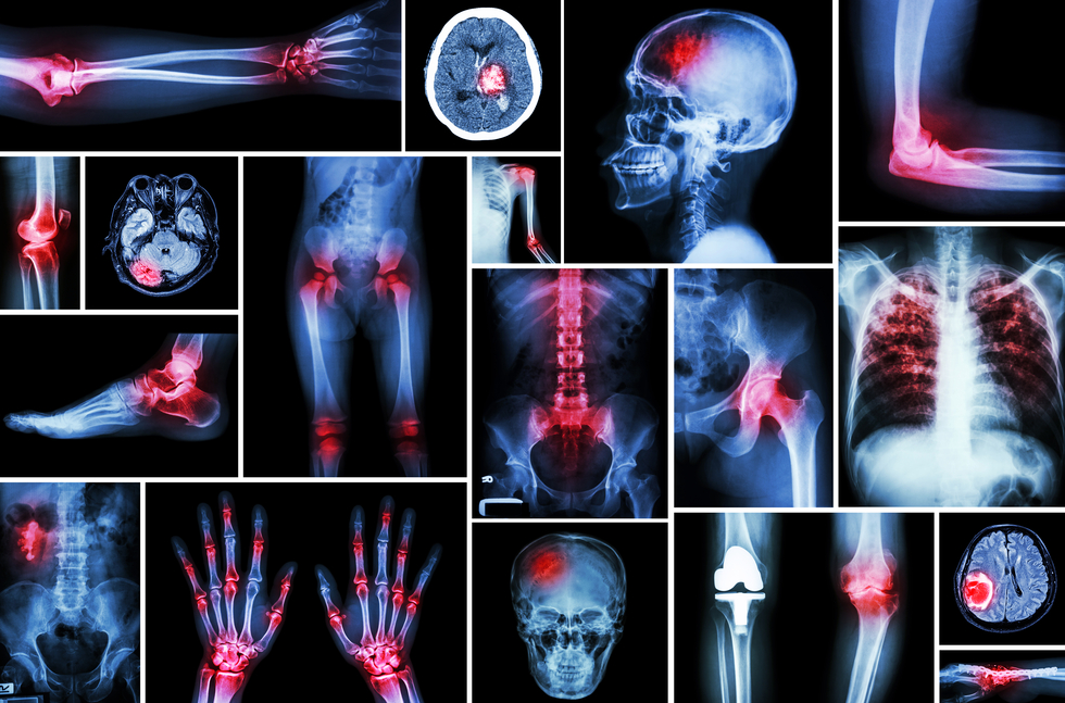 Osteoarthritis Cannabis lindert Schmerzen